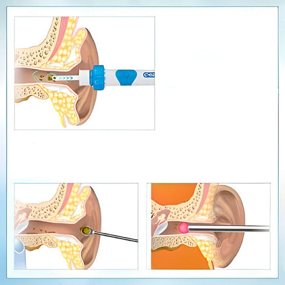 Precise Ear Cleaning Device with Suction